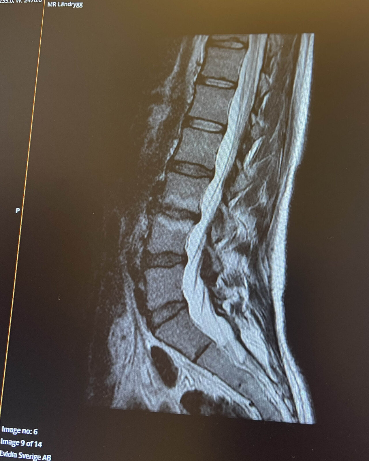 Modicförändringar – min resa med ryggsmärta - Petra Månström